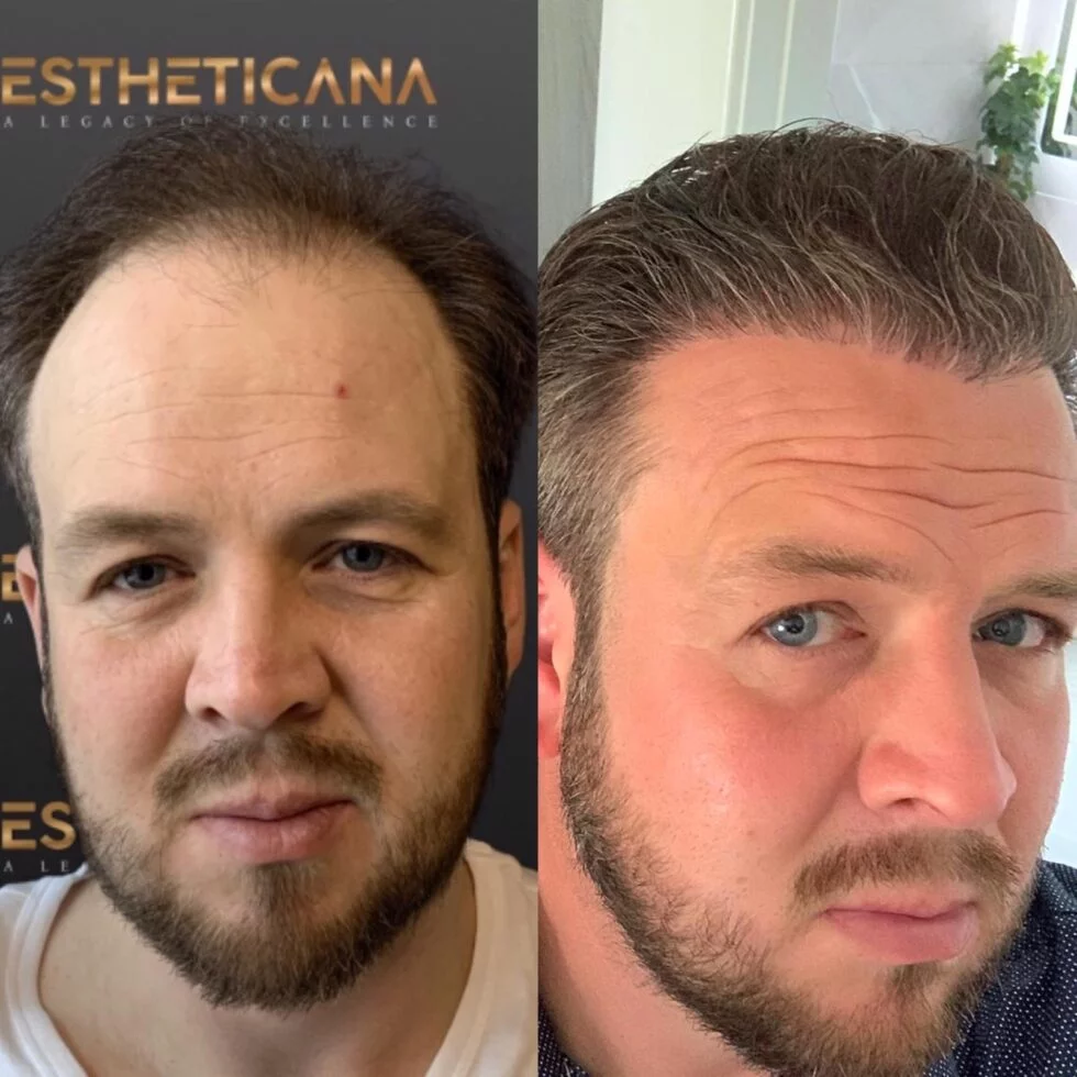 Hair Transplantation Before And After - Estheticana