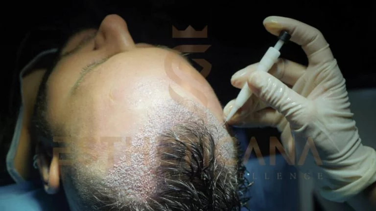 PRICING Hair Transplant ın Turkey