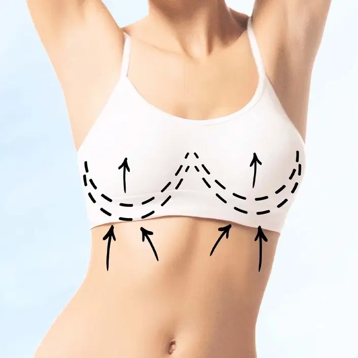 breast lift