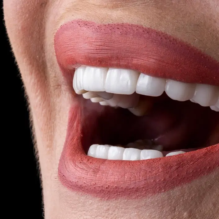Hollywood Smile
