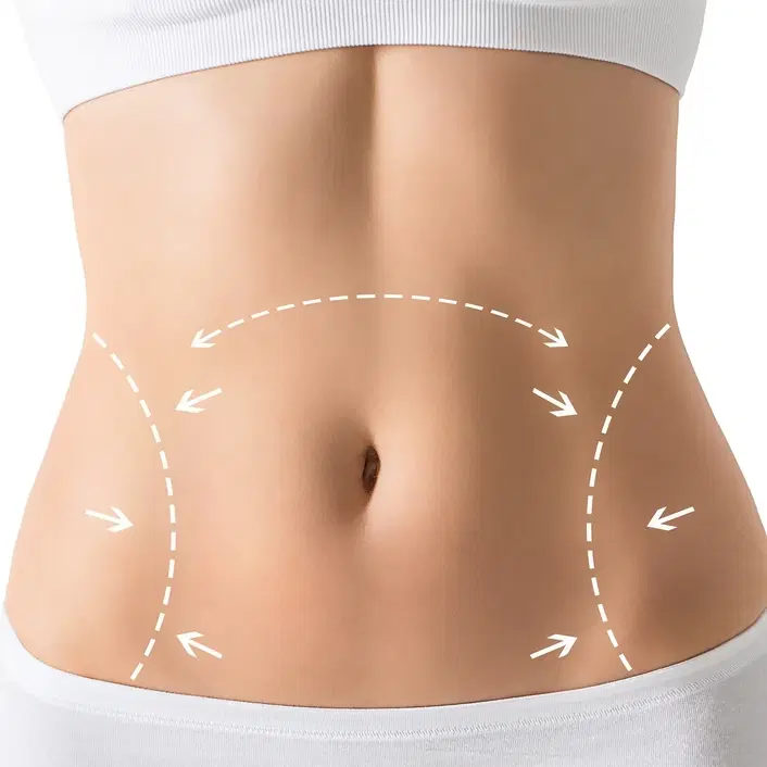 abdominoplasty