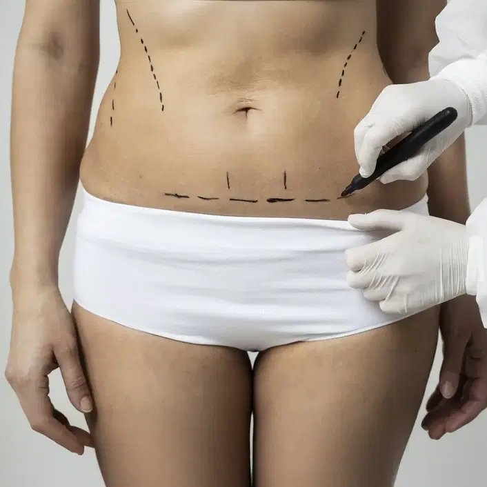 liposuction