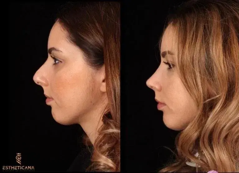 Rhinoplasty in Turkey