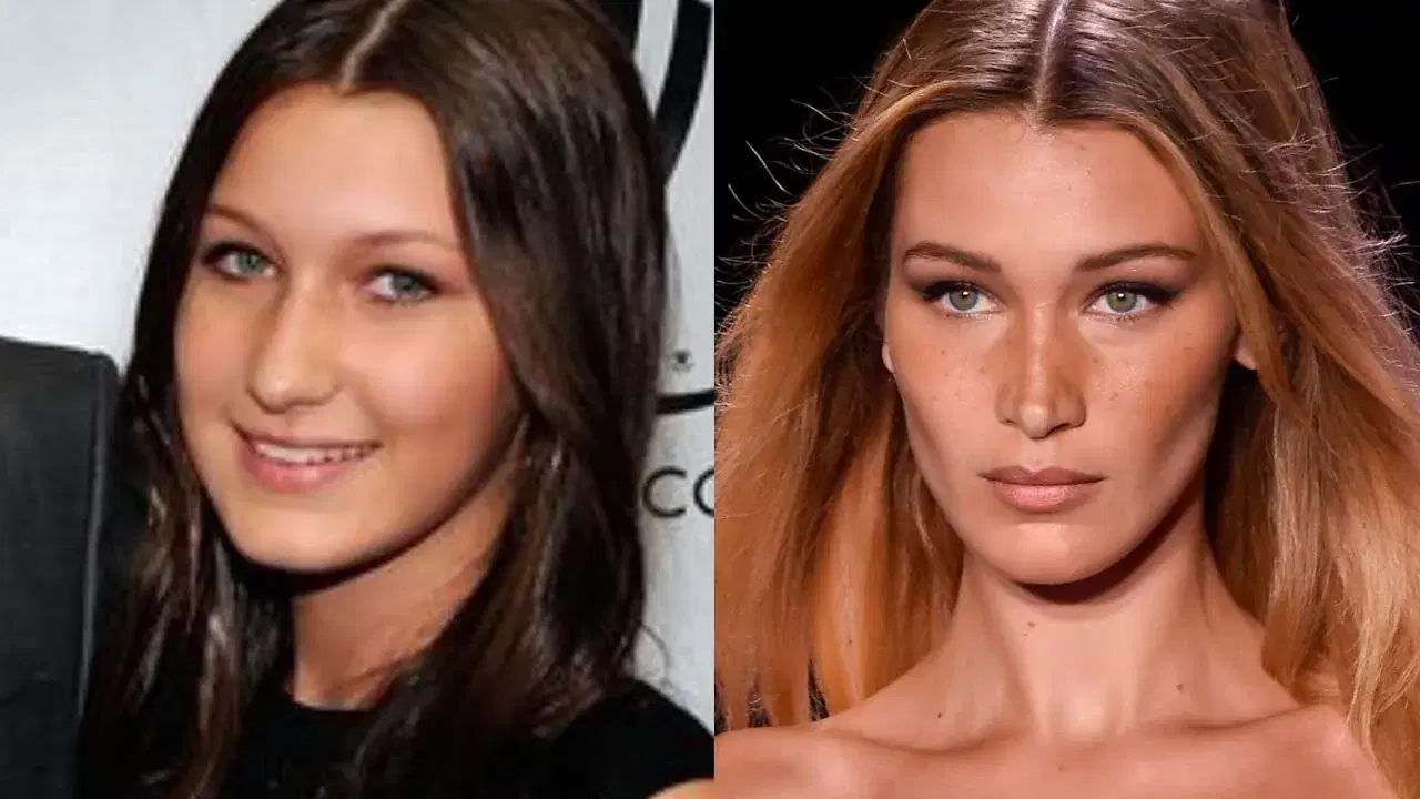 Celebrities Who Have Had Rhinoplasty