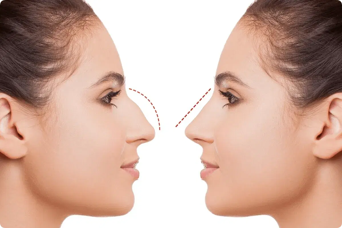 Different Rhinoplasty Techniques