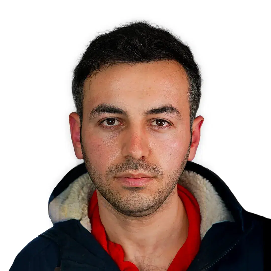 Hair transplant result after 8 months with 4300 grafts in England