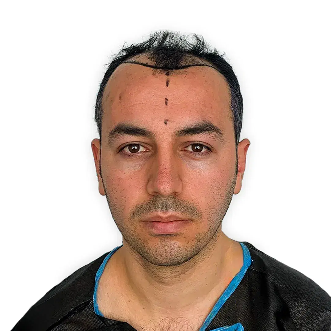 Hair transplant before treatment with 4300 grafts in England