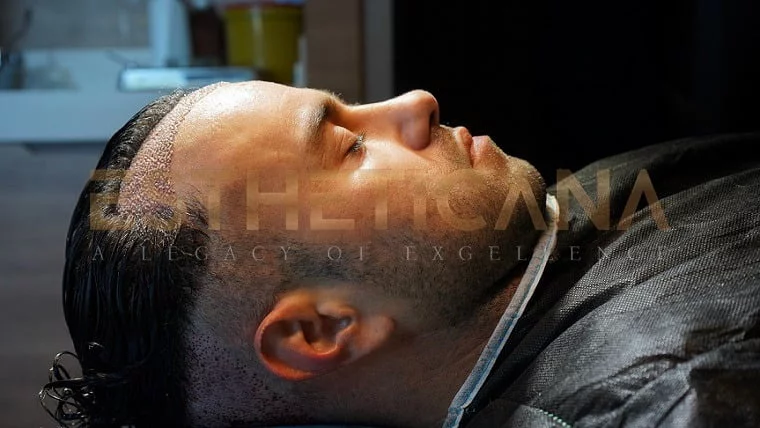 How Can I Fix My Hairline? Receding Hairline Treatment - Estheticana
