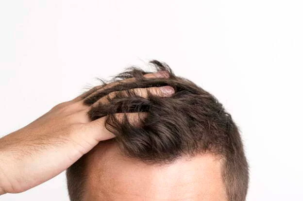 When Will Results Of Hair Transplantation Appear? - Estheticana image