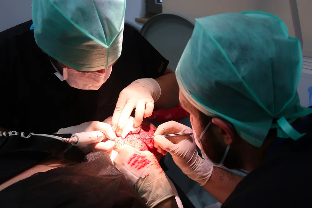 Hair Transplant