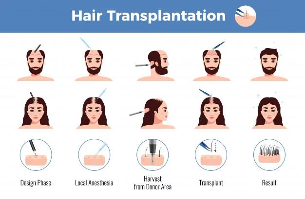 8 Reasons To Have Fue Hair Transplant - Estheticana image