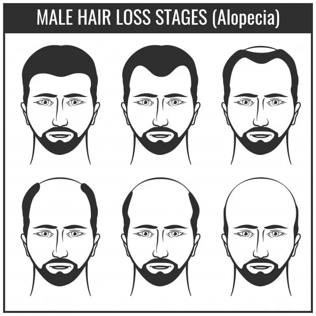 Norwood Scale: What Are The 7 Stages Of Hair Loss? - Estheticana