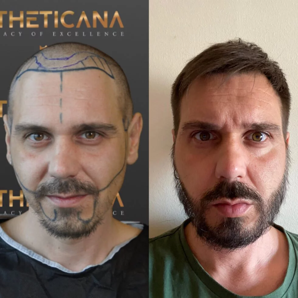 Hair Transplant Results - Estheticana image