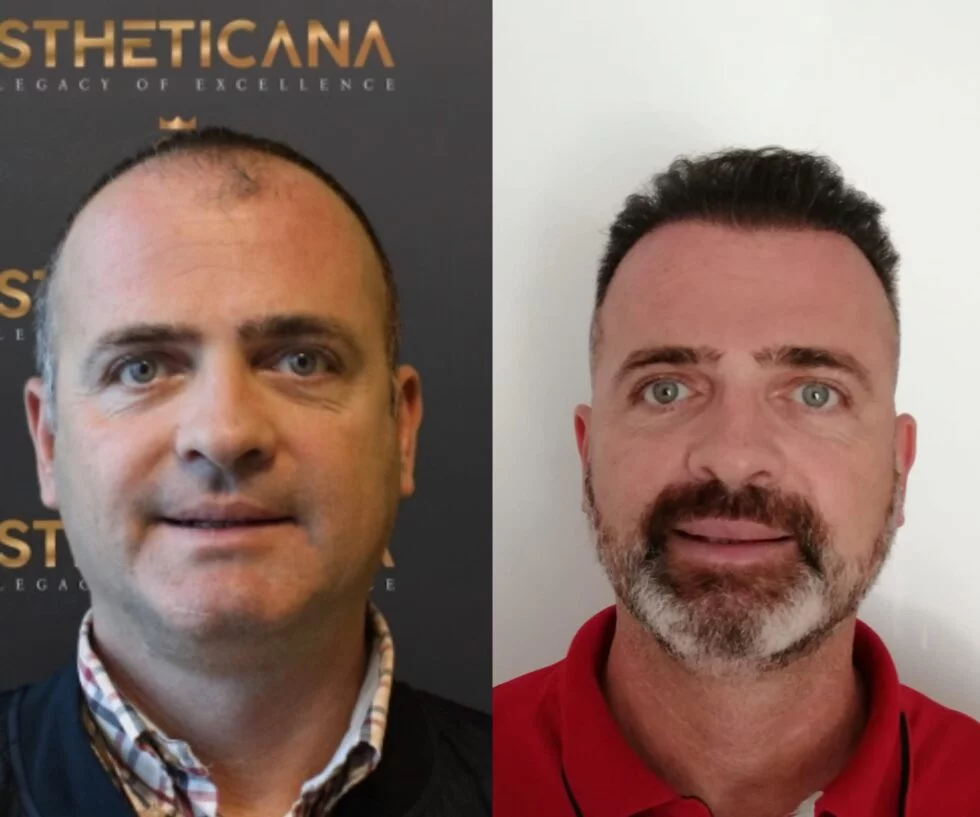 How Is A Hair Transplant Done? Operation Process With All Details - Estheticana image
